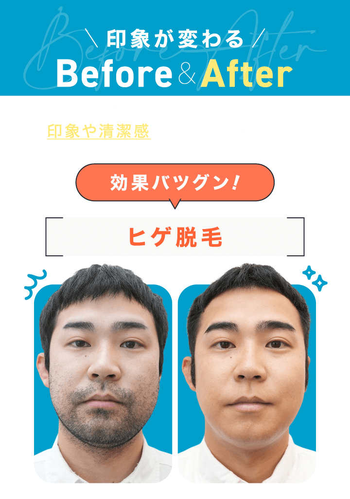 ヒゲ脱毛のビフォーアフター
